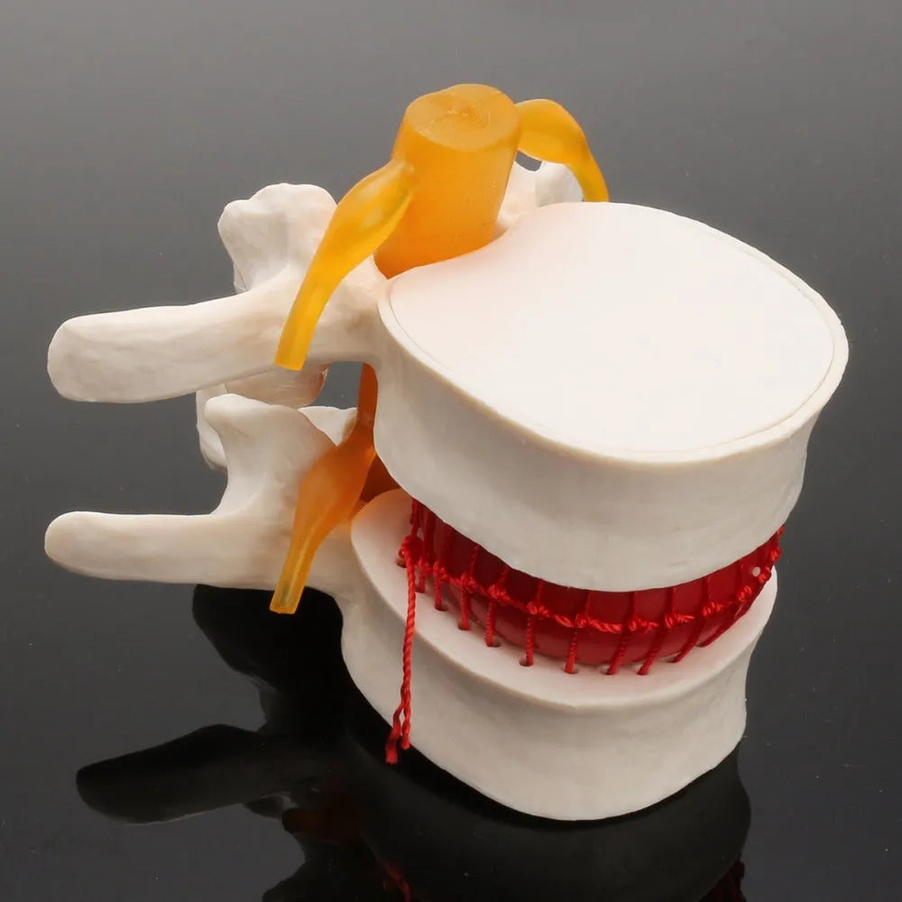 White PVC medical model demonstrating a herniated lumbar intervertebral disc.