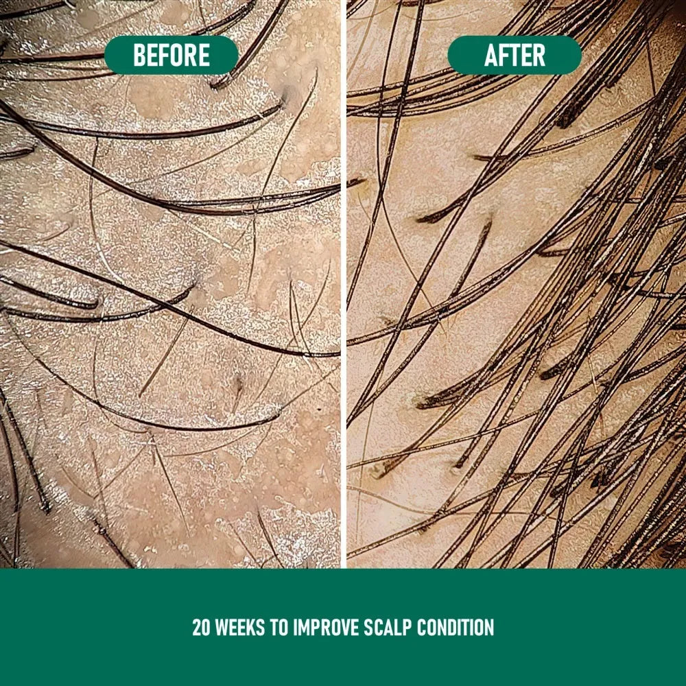 CH004 Minoxidil Anti-Hair Loss Mousse foam product for scalp treatment, set box and single piece