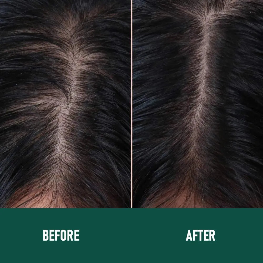 CH004 Minoxidil Anti-Hair Loss Mousse foam product for scalp treatment, set box and single piece