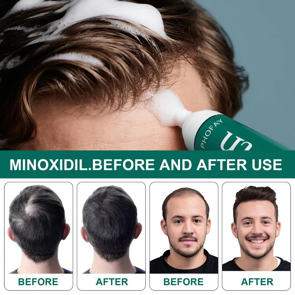 CH004 Minoxidil Anti-Hair Loss Mousse foam product for scalp treatment, set box and single piece