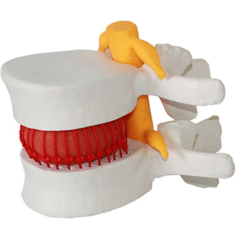 White PVC medical model demonstrating a herniated lumbar intervertebral disc.
