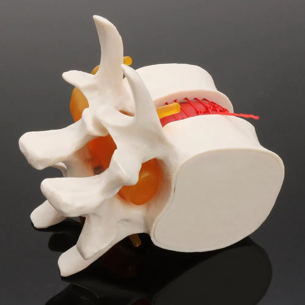 White PVC medical model demonstrating a herniated lumbar intervertebral disc.