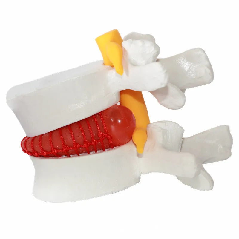 White PVC medical model demonstrating a herniated lumbar intervertebral disc.