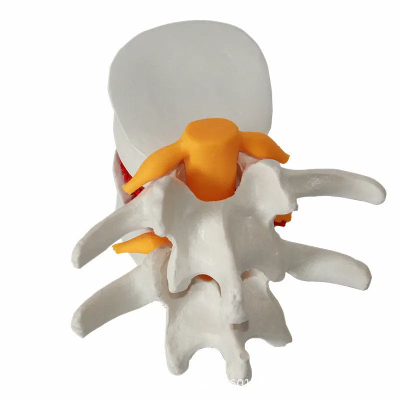 White PVC medical model demonstrating a herniated lumbar intervertebral disc.