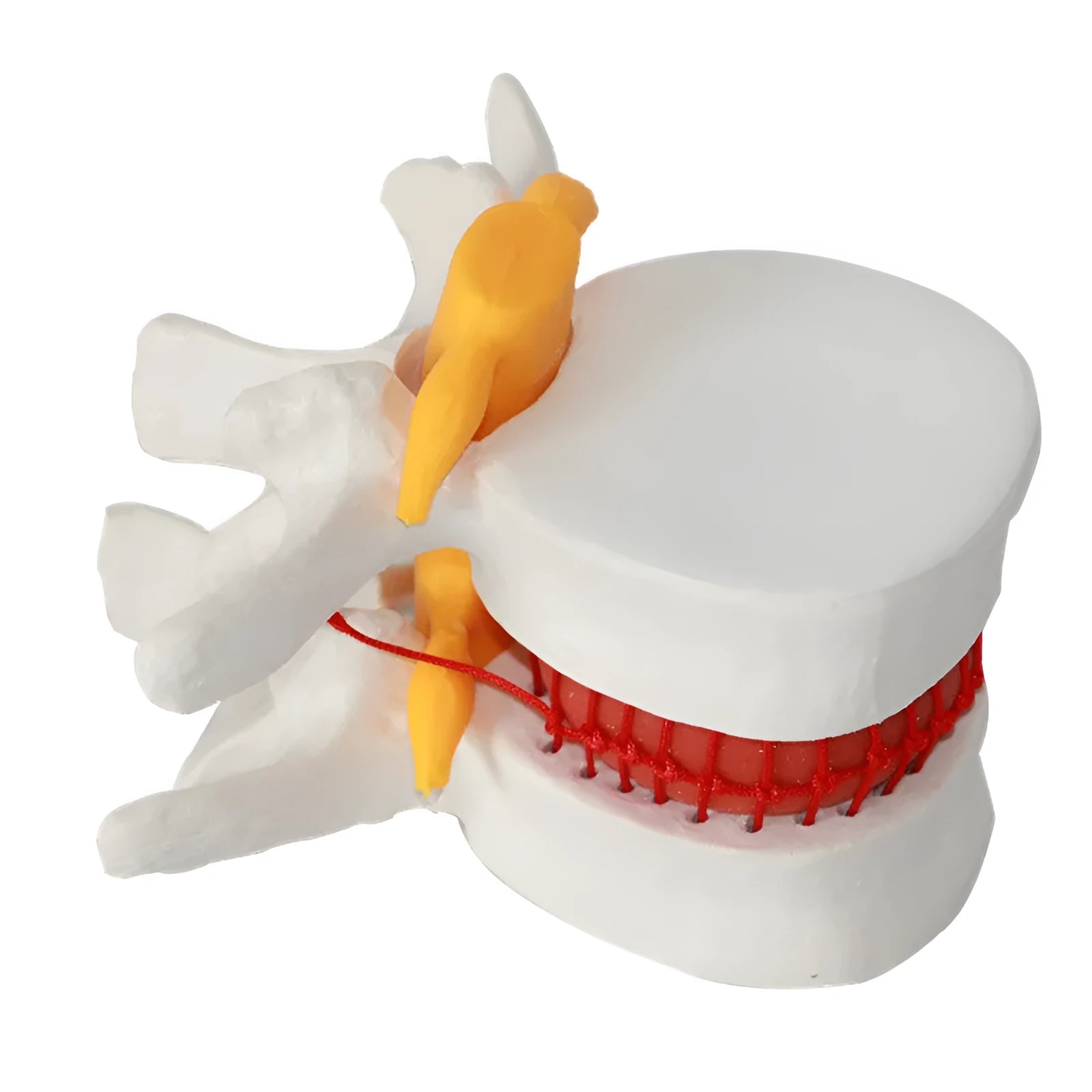 White PVC medical model demonstrating a herniated lumbar intervertebral disc.