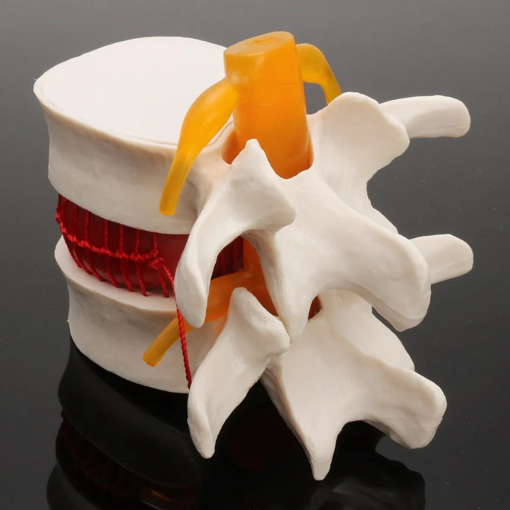 White PVC medical model demonstrating a herniated lumbar intervertebral disc.