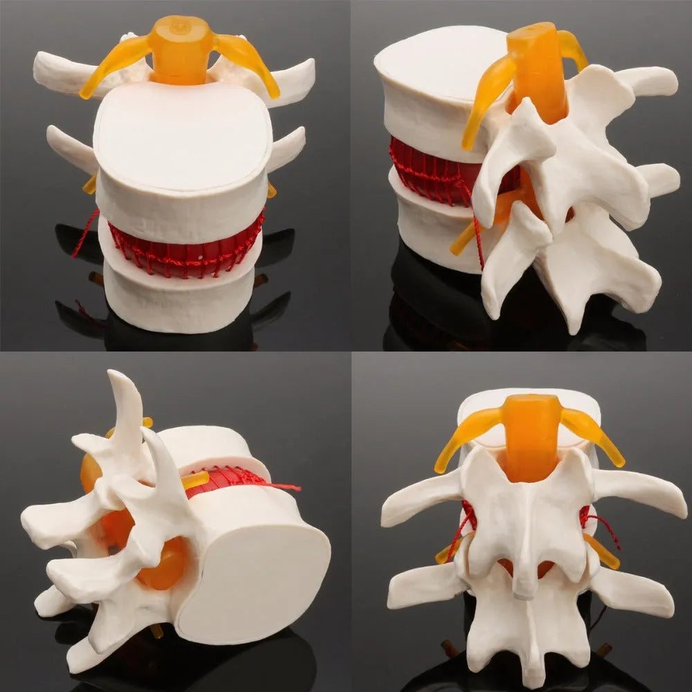 White PVC medical model demonstrating a herniated lumbar intervertebral disc.