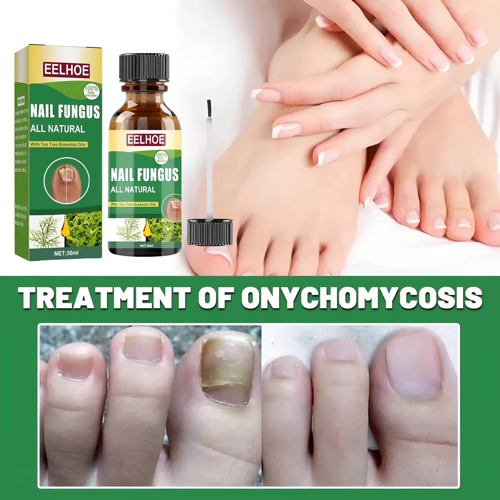30ml bottle of tea tree oil nail repair solution for thickened hand and foot nails