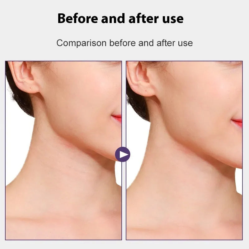 Skin-tone neck firming adhesive tape set with four lifting strips and twenty replacement patches