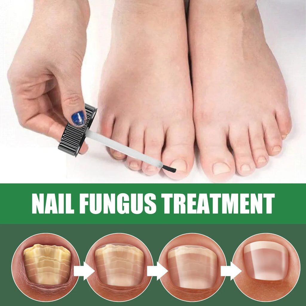 30ml bottle of tea tree oil nail repair solution for thickened hand and foot nails
